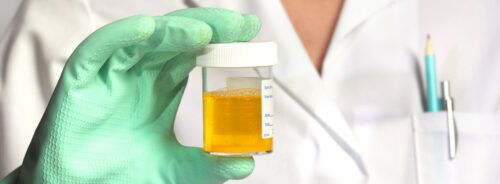 exame de urina: pote de urina